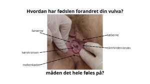 hvordan har fødslen forandret din vulva