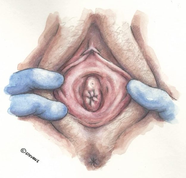 vulva i puberteten vulva i puberteten